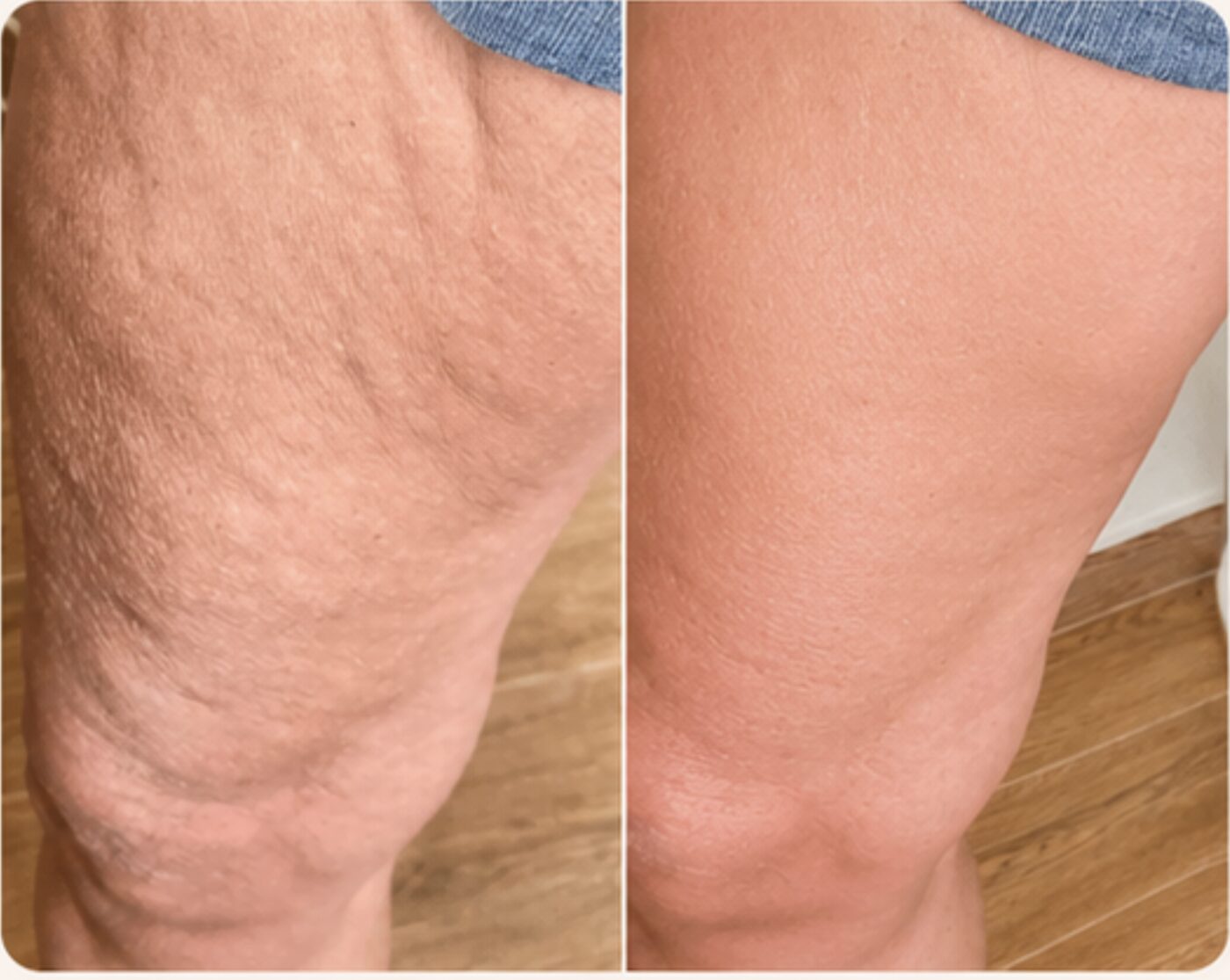 Body — before and after result at Beauty & Body by Sifra