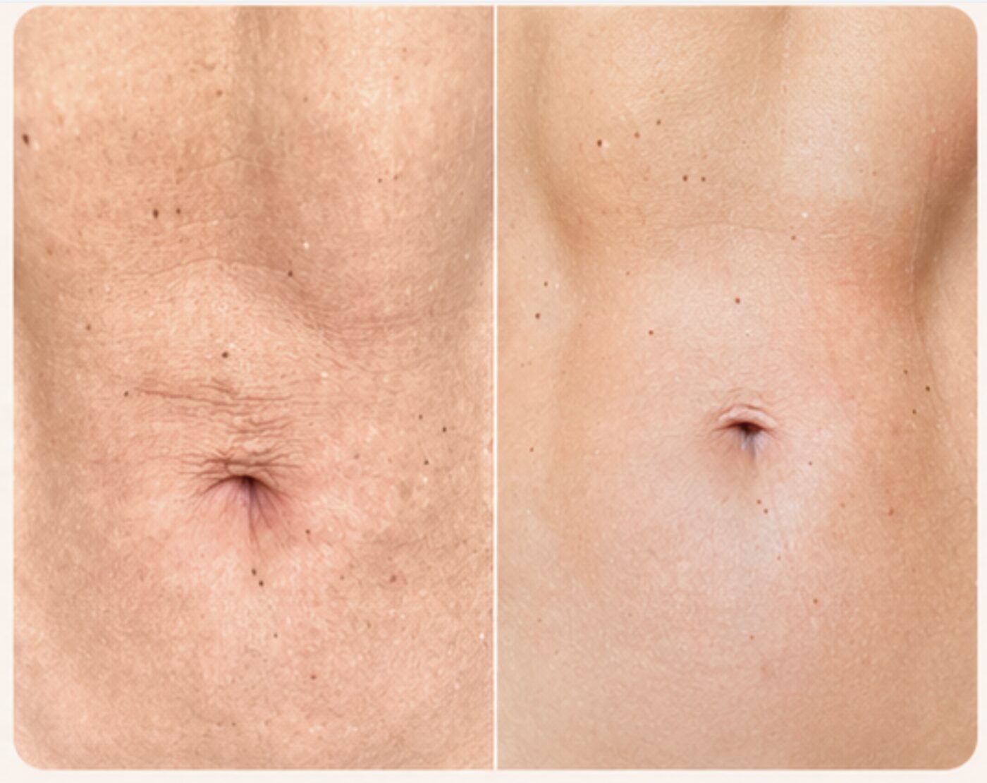 Tone, Lift & Sculpt — before and after result