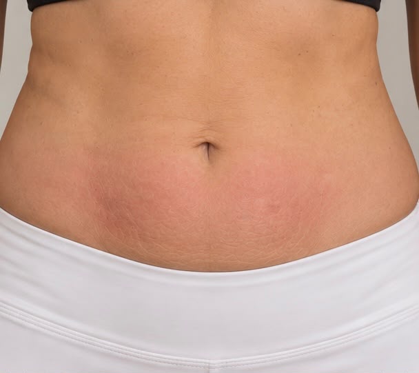 Bye Bye Stubborn Fat + EMS Sculpting with RF after