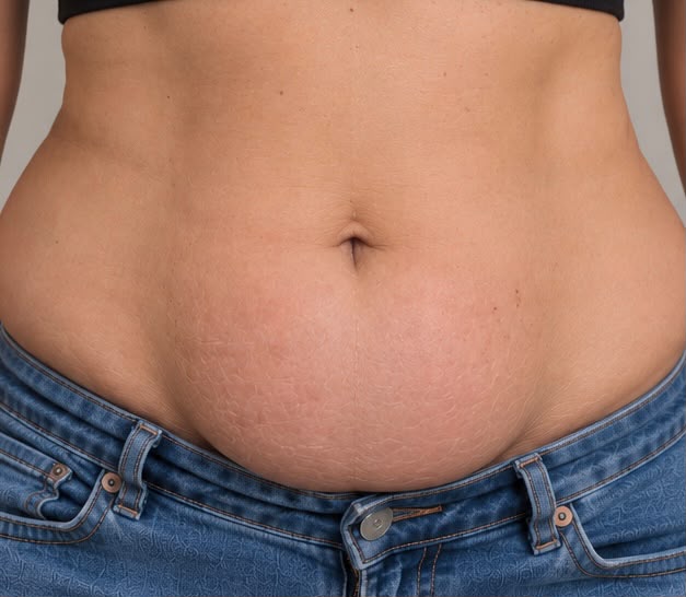 Bye Bye Stubborn Fat + EMS Sculpting with RF before