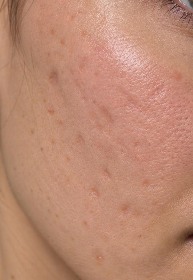 EGF Microneedling after
