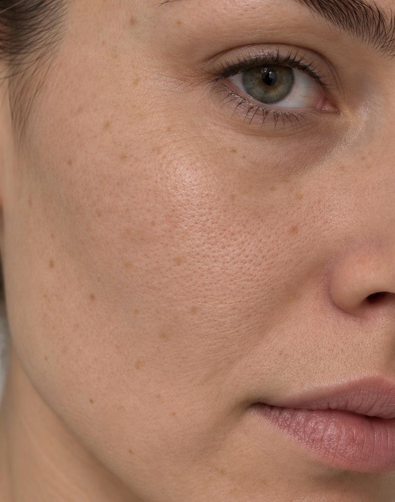 The Peel & Glow Therapy before